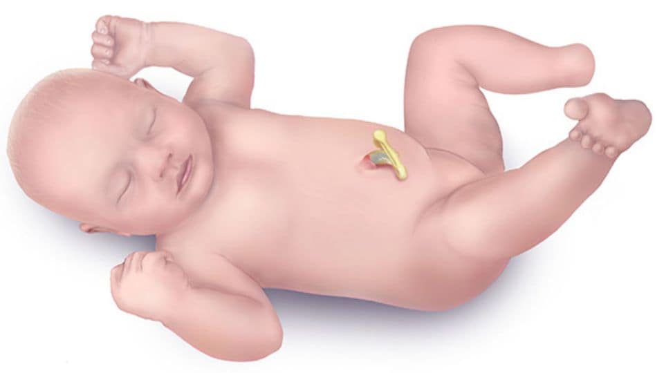 Illustration of a newborn baby with a limb reduction