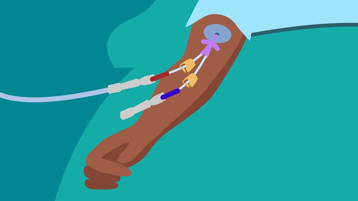 ilustration of a patient's arm on hospital bed. A picc line with two tubes is on the arm.