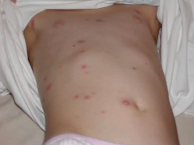 Stomach of child with light skin with breakthrough varicella. Source: Varicella Active Surveillance Project.