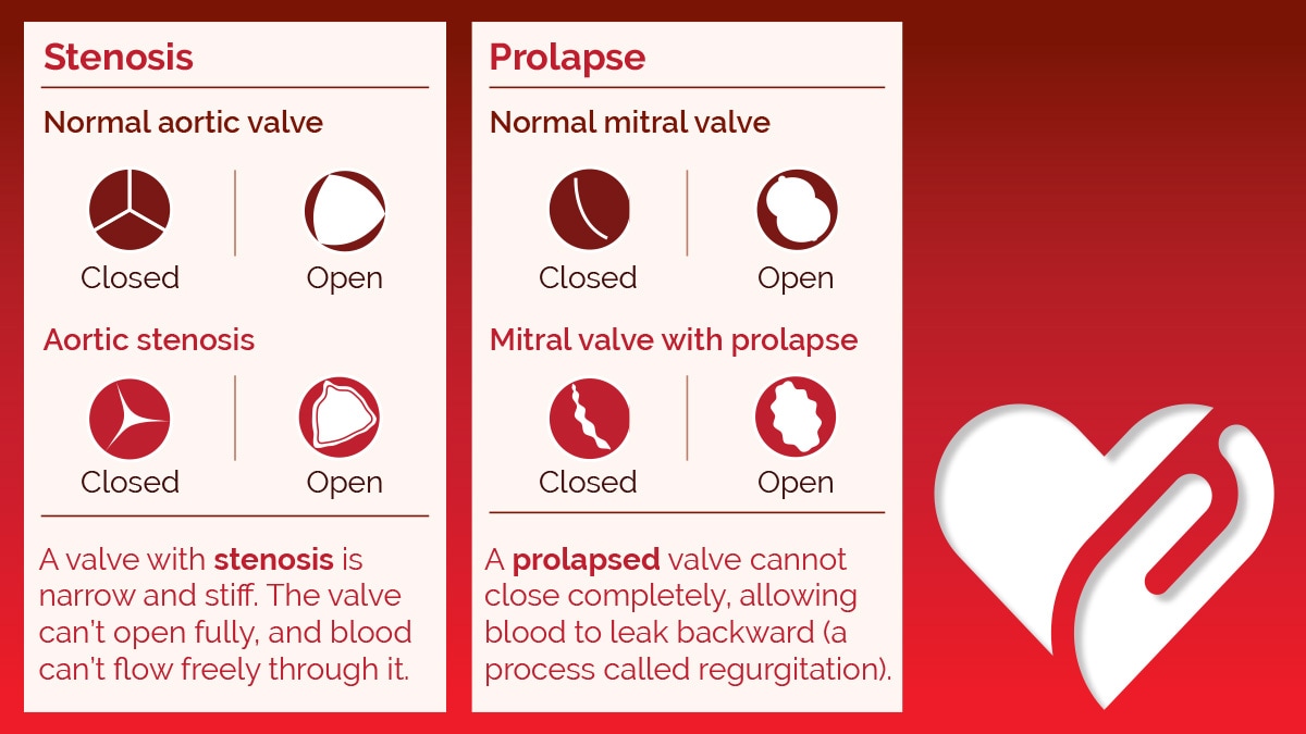 Figures with text explaining stenosis and prolapse and eight small images illustrating open and closed positions of both normal and diseased versions of aortic and mitral valves. A valve with stenosis is narrow and stiff. The value can't open fully, and blood can't flow freely through it. A normal aortic valve, when closed, has three equal-sized slice-shaped flaps within a circle that close to form a Y-shaped seal. When open, the normal aortic valve has the flaps open to form an almost perfect circular cross-section with very small protrusions into the blood flow. An aortic valve with stenosis, when closed, has flaps that do not form a Y-shaped seal, instead leaving a cavity at the junction of the flaps where blood can trickle through. When open, the flaps are not fully open, forming a smaller, triangular cross-section. A prolapsed valve cannot close completely, allowing blood to leak backward, a process called regurgitation. A normal mitral valve, when closed, has two gibbous moon-shaped flaps that forma  parenthesis-shaped seal. When open, the normal mitral valve has flaps open that form an almost perfect circular cross-section with very small protrusions into the blood flow. A mitral valve with prolapse, when closed, has two gibbous moon-shaped flaps that do not seal, leaving several gaps between the valves where blood can trickle through. An open mitral valve with prolapse has flaps that do not fully open, forming a smaller, elliptical cross-section.