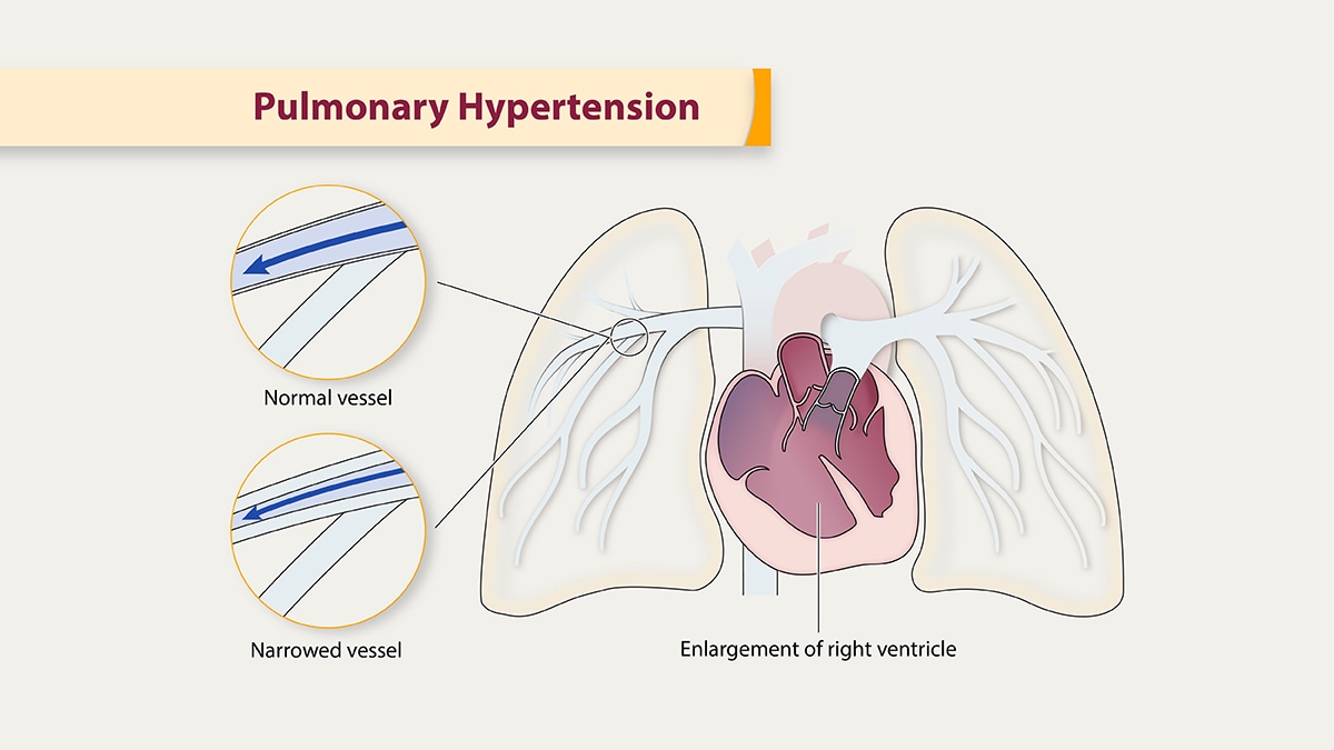 Illustration of the lungs and heart, and enlargement of the right ventricle.