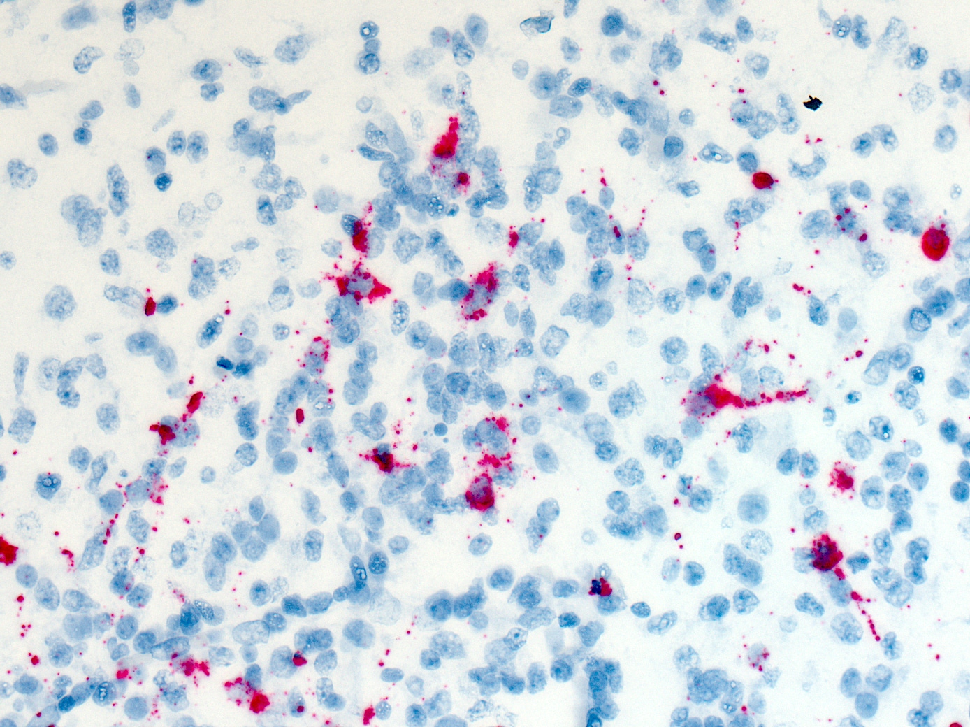 In situ hybridization (ISH) showing Zika virus replicating in neurons in the brain of an infant in 2017