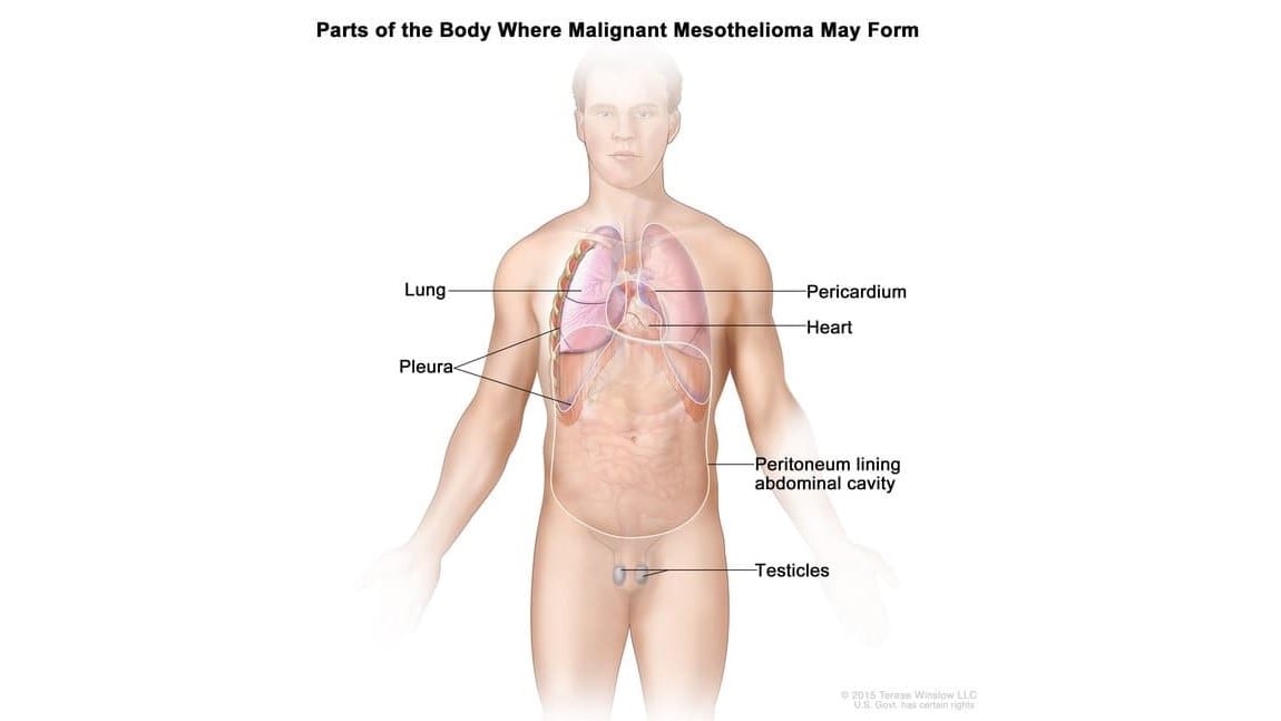 Drawing shows parts of the body where malignant mesothelioma may form.