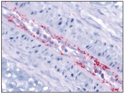 This figure is a photograph showing an immunohistochemical stain demonstrating Rickettsia rickettsii (red) in infection of blood vessel endothelial cells.