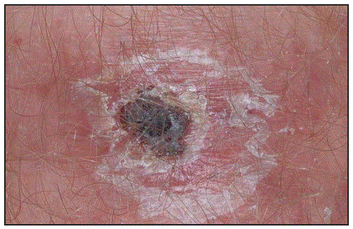 The figure is a photograph of a Rickettsial disease eschar from a patient with Rickettsia parkeri rickettsiosis.