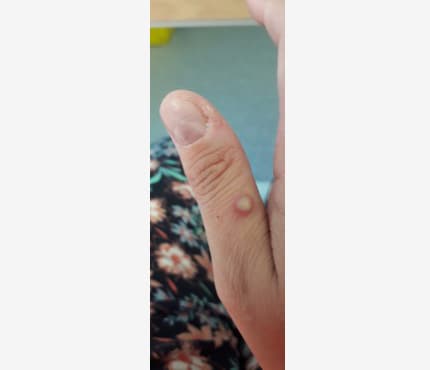 Photo of a small, raised bump on on person's thumb