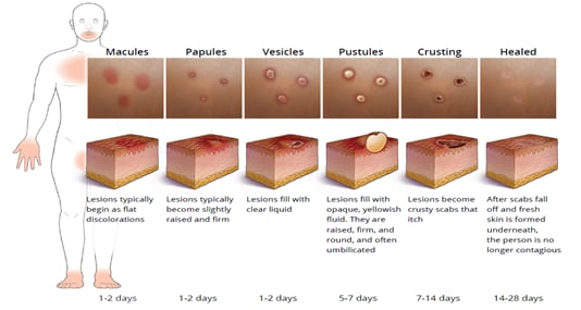 The stages of mpox lesions from the time they appear to the time they heal and a fresh layer of skin forms.