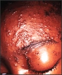 Person with dark skin presenting shingles rash on face.