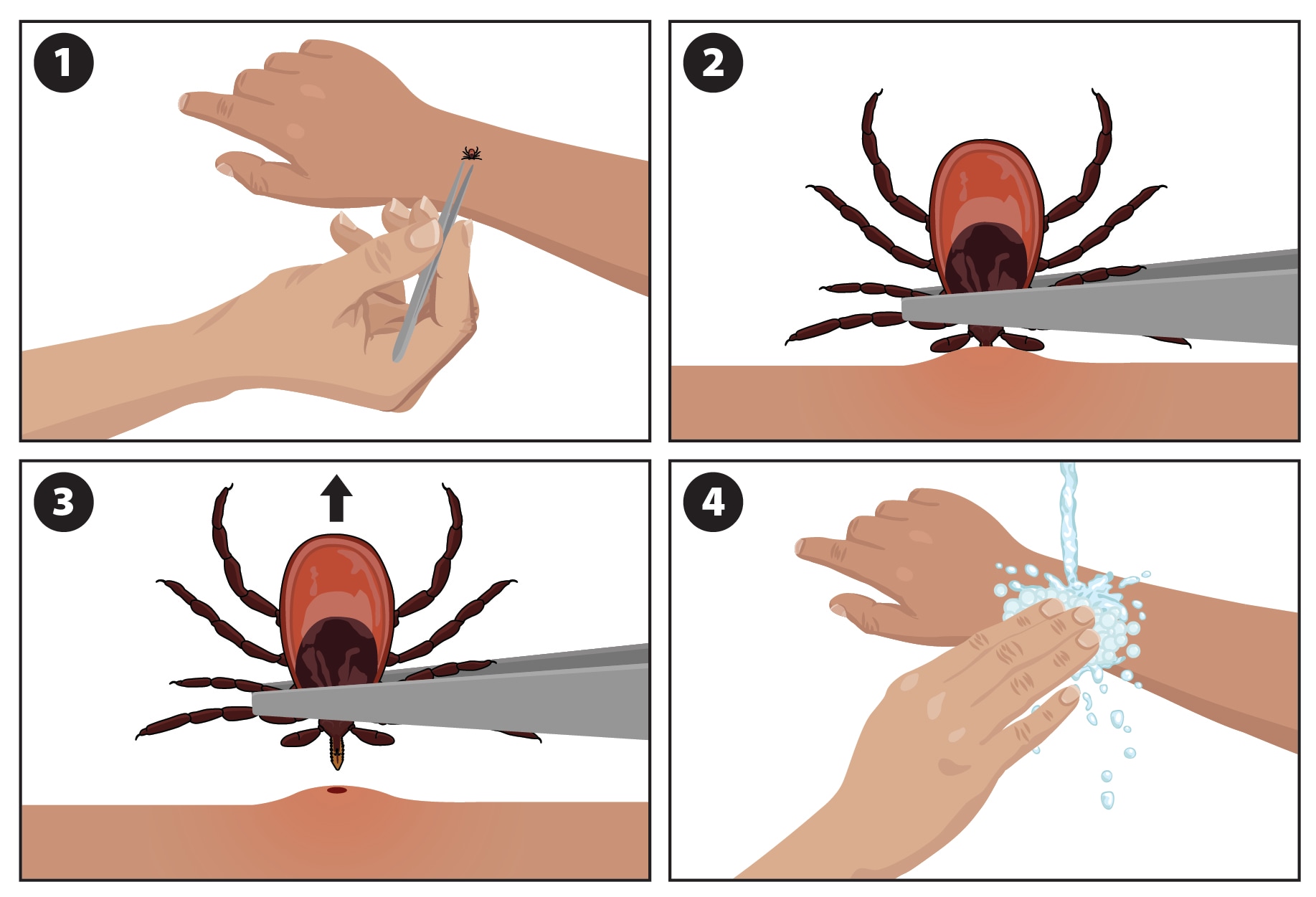 Illustration showing how to remove a tick (Ixodes scapularis pictured).