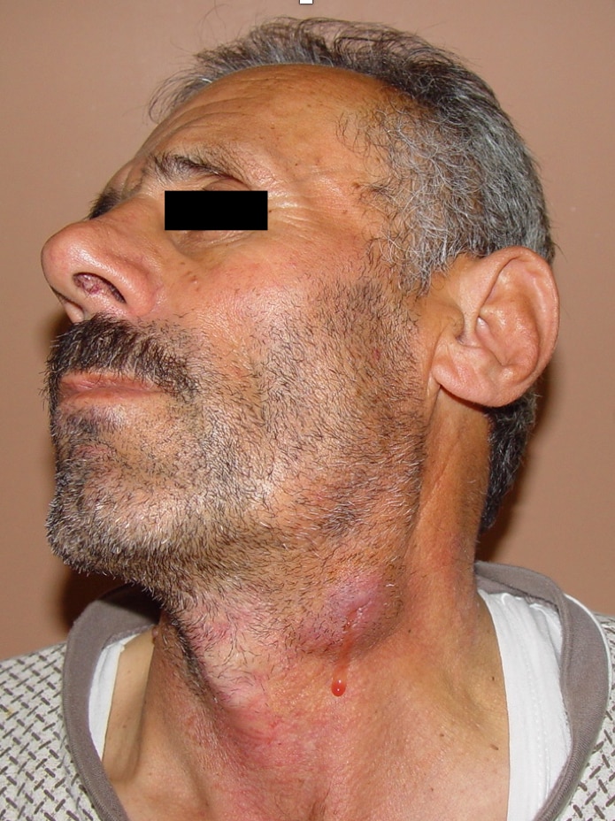 Cervical lymphadenopathy with fistula