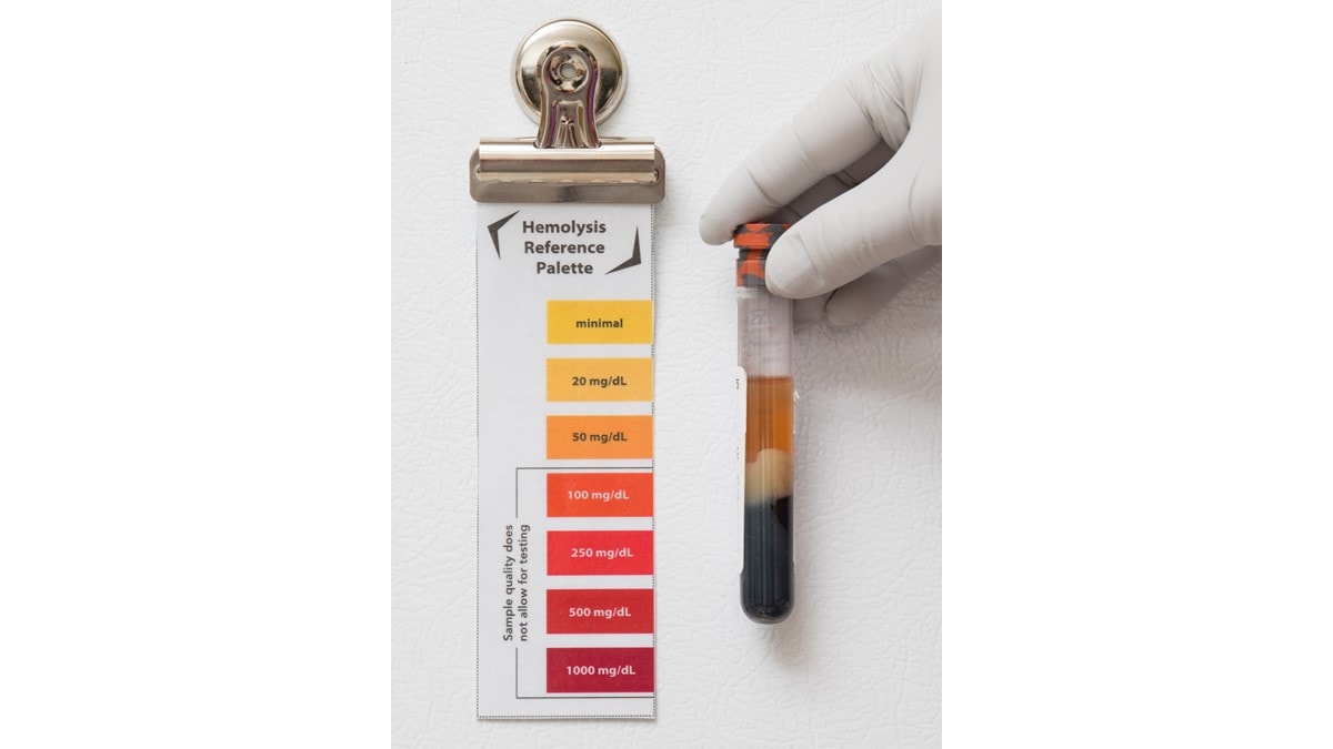 A lab technician wearing gloves holds a tube adjacent to the Hemolysis Reference Palette to determine status.